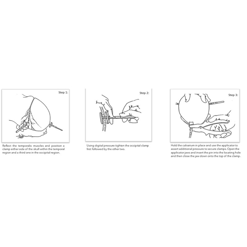 Ezi Calvarium Clamps