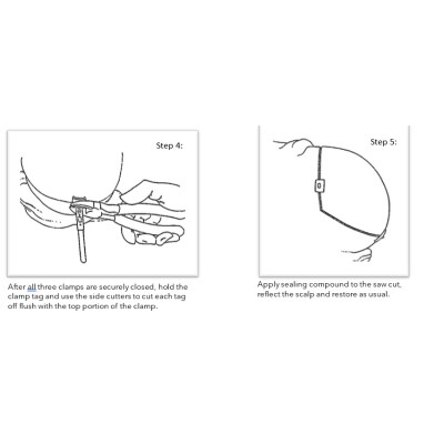 Ezi Calvarium Clamps