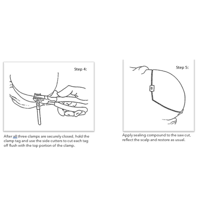 Ezi Calvarium Clamps